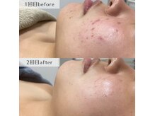 ネイルズビー 別邸(Nail's be)の雰囲気(繰り返すお肌悩みにも◎ハーブピーリング6回で肌質改善)