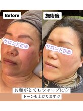 サロン ド 花歩 松山本店/小顔キャビエステ☆施術１回