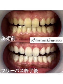 ホワイトニングサロン 京都烏丸店/ホワイトニング施術例