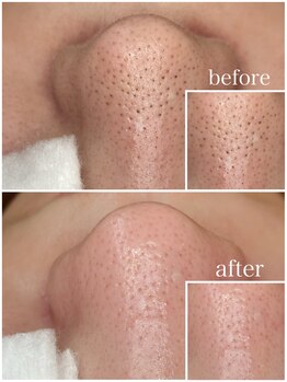 毛穴専科/毛穴洗浄+白玉ワックス メンズ◎