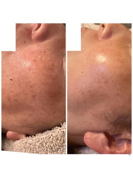 アンド ユー(and.yu)/シミケア・美肌コース1回