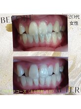 ココホワイトニング(coco whitening)/プラチナコース８分照射×５回