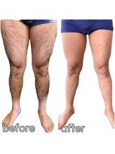 キガルモ 宇都宮店/脱毛ビフォーアフター