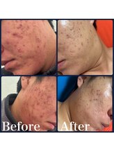 オルズ(Olu's)/ハーブピーリング｜ニキビ