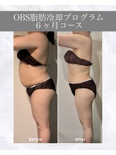 OBS/脂肪冷却プログラム