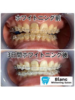 ブラン 心斎橋店(Blanc)/矯正中のゲスト様の施術例