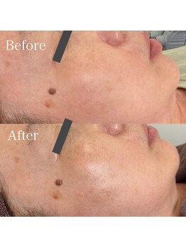 ベルカーラ(Belcarra)/肌質改善美肌フェイシャル