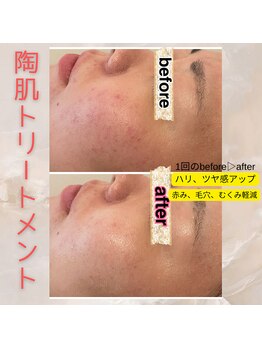 プルーム 大橋店(plume)/ハーブピーリング