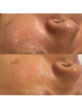 マボーテ 恵比寿(Ma-Beaute)の写真/何度も繰り返す肌悩みに！【リアボーテタラソトリートメント】結果重視の方も満足するほどお肌の変化を実感