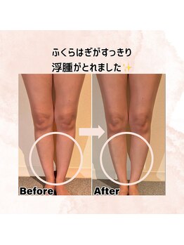 ポノ インディバ サロン(pono. Indiba salon)/浮腫み/X脚・O脚