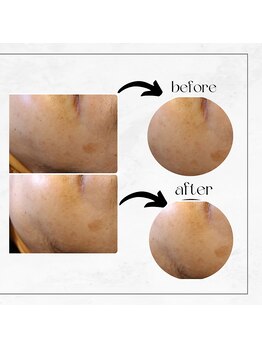 リル(RIRE)/プラズマエステ