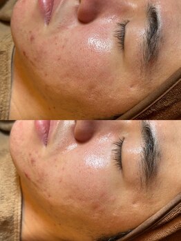 ゼニス 池袋本店(ZENITH)/乳酸菌セラピール☆