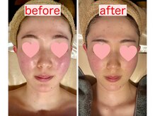 サロン ド ミコ(Salon de Mico)/20代　水素フェイシャル5回