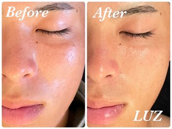 ルース(LUZ)/お客様施術例(毛穴ケアエステ)