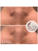 ルーナ(LUNA)/☆ハイドロスキン1回施術結果☆
