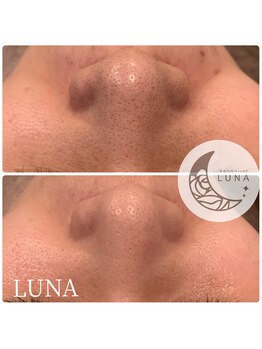 ルーナ(LUNA)/☆ハイドロスキン1回施術結果☆