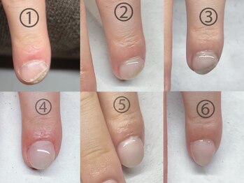 プチムトン 鶯谷店(petit mouton)/【深爪矯正コース】1