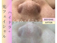 Cスキンケアクリニック 麻布店/ハイドラ＋光フェイシャル