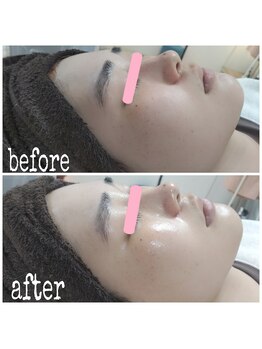 ピュルテ/ピーリングに少し抵抗のある方に