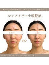 メラリノ(Melalino)/シンメトリー小顔整美