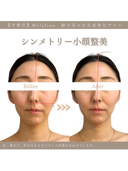 メラリノ(Melalino)/シンメトリー小顔整美