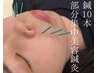 ☆お試し！☆【電気なしで初めてでもおすすめ】　美顔鍼10本部分集中鍼　45分