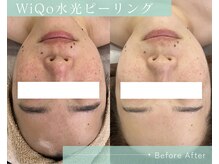リノア 柏(Lino'a)/WiQo水光ピール+保湿1クール5回