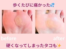スロース鍼灸整体院(SLOTH鍼灸整体院)/歩くと痛かったタコがなくなり！
