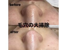 ビューティーネイル(Beauty Nail)/毛穴エクストラクション