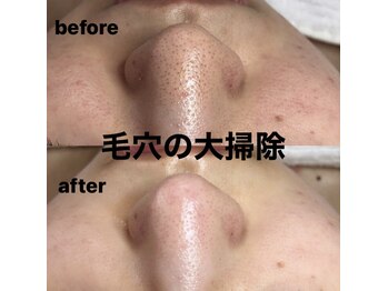 ビューティーネイル(Beauty Nail)/毛穴エクストラクション