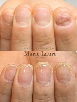 マリーロール 淀屋橋本店(Marie Laure)/自爪育成/深爪矯正/ネイルケア