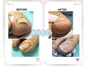 巻き爪補正(片側1箇所)軽度の方¥5500