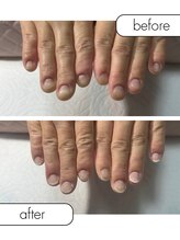 ピノ(pino)/◆深爪矯正自爪の変化◆