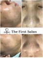 ザ ファーストサロン(The First Salon) メンズの肌改善にも有効です