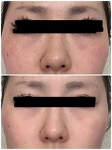 エステサロン ベリシモ(Bellissimo)/フェイシャル/ビフォーアフター