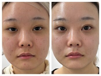 センガン(SENGAN)/ハーブピーリング