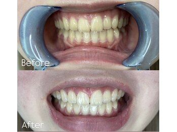 ウルト(ULT)/セルフホワイトニング