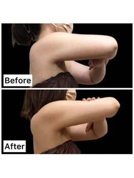 クールヴィラ(Cool Villa)/二の腕ビフォーアフター