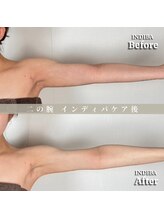 術後の女神 大阪心斎橋店/術後ケアインディバ・インディバ