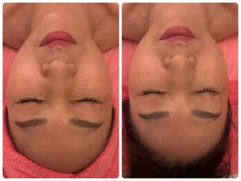 サロンドデュイ/1回施術/50代/ レチノール