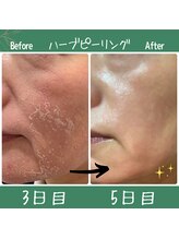 レアルステイト 金沢店/ハーブピーリング/毛穴/ニキビ