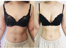 オリーブ 金沢(Olive)/バストアップ★育乳症例