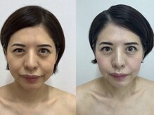 カブール 町田/ほうれい線ケア対策に！