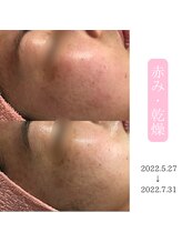 ベストベル(BestBelle)/乾燥や赤ら顔もお任せください！