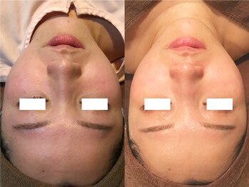 ソイズ 新保店(SOIS)/フェイシャルWAX