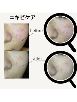 アノネ(Anone.)/ハーブピーリングBefore After