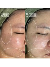 サロンドジェシカ(salon de Jessica)/プラズマ＋毛穴洗浄