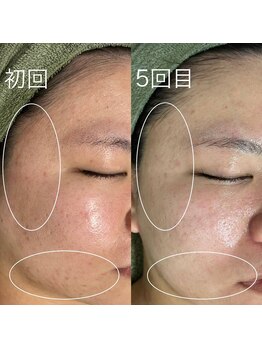 サロンドジェシカ(salon de Jessica)/プラズマ＋毛穴洗浄