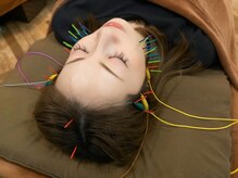 アラキ(ARAKI)/むくみに美容鍼をご体感ください