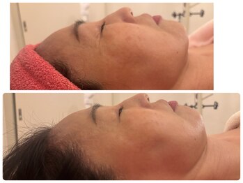 サロンドデュイ/1回施術/50代/ レチノール